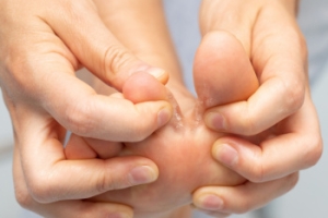Symptoms and Treatment of Athlete&#039;s Foot