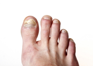 Toenail Fungus and Nail Polish