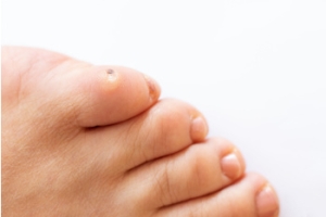 Corns and Calluses Can Cause Discomfort in the Feet