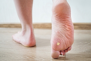 Painful Plantar Warts