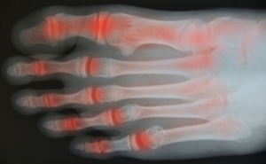 Treating Painful Symptoms of Rheumatoid Arthritis