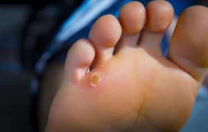 Two Types of Corns on the Feet