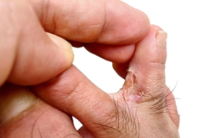 Causes of Athlete’s Foot