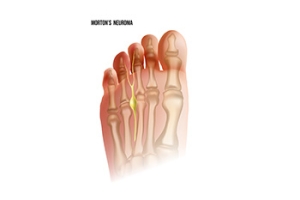 The Truth About Morton&#039;s Neuroma
