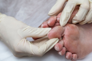 Making the Right Decision for Severe Diabetic Feet