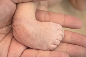 Managing Clubfoot