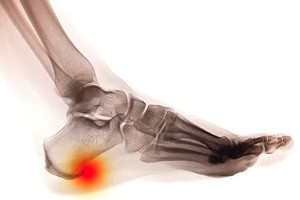 Two Types Of Heel Spurs
