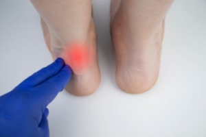 What Is Achilles Tendinopathy?