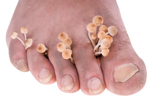 Athlete&#039;s Foot a Problem at Gyms