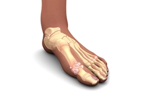 An Overview of Gout
