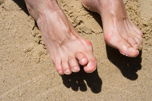 Hammertoe Is a Common Deformity