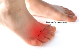 Treatment Options for Morton’s Neuroma
