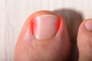 When Do You Need Surgery for an Ingrown Toenail?