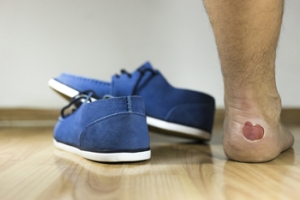 Runners and Blisters